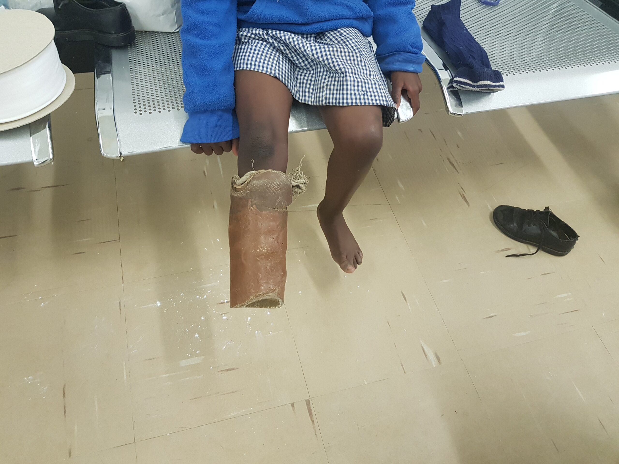 Overused Prosthetic leg