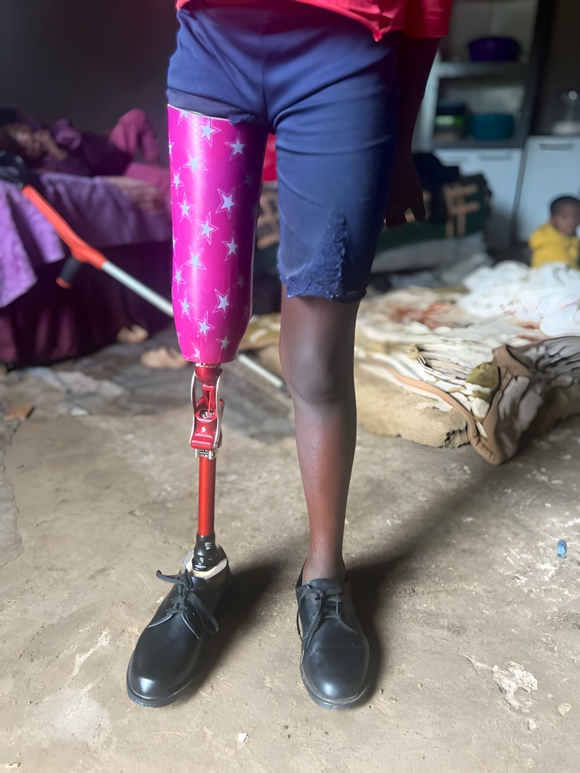 Prosthetic Fitting