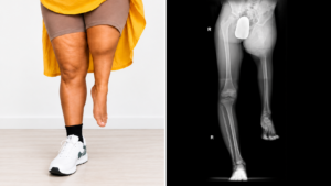 Side-by-side clinical photograph and lower-limb radiograph showing the shortened affected limb and femoral deficiency associated with PFFD.